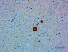 IHC staining of HRP anti-α-Synuclein, aggregated antibody (clone A17183G) on formalin-fixed paraffin-embedded Parkinson’s disease brain tissue. See full product details here.